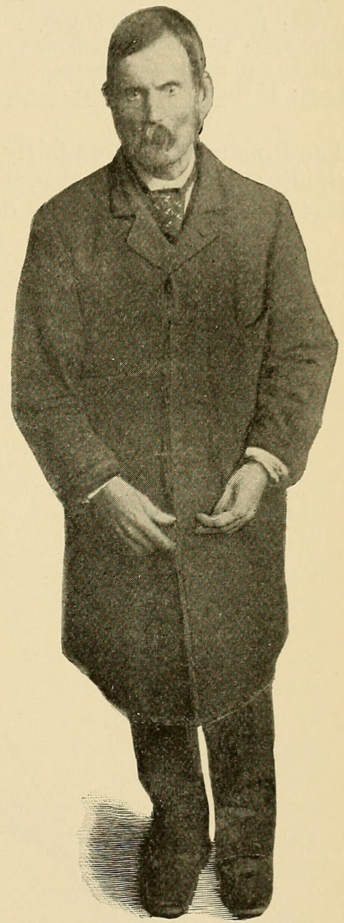 Parkinson's Disease Historical Illustration